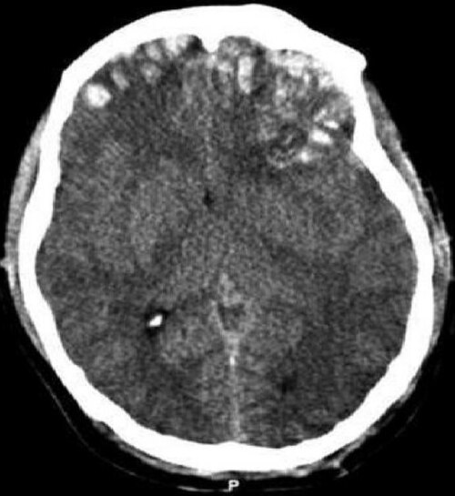 traumatic brain injury